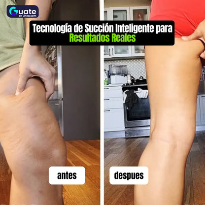 SuctionSmart – Terapia Avanzada para Celulitis