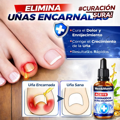 🦶 ¡Alivio Inmediato para Uñas Encarnadas y Paroniquia!