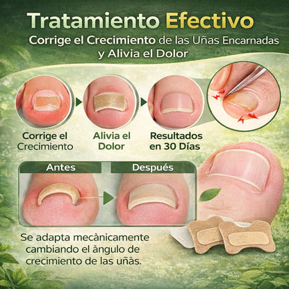 🦶 Adiós al Dolor de Uñas Encarnadas – ¡Recupera tus pies sin cirugía! 🔥